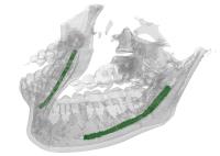 Segmentation of the IAN Canal in CBCT Volumes
